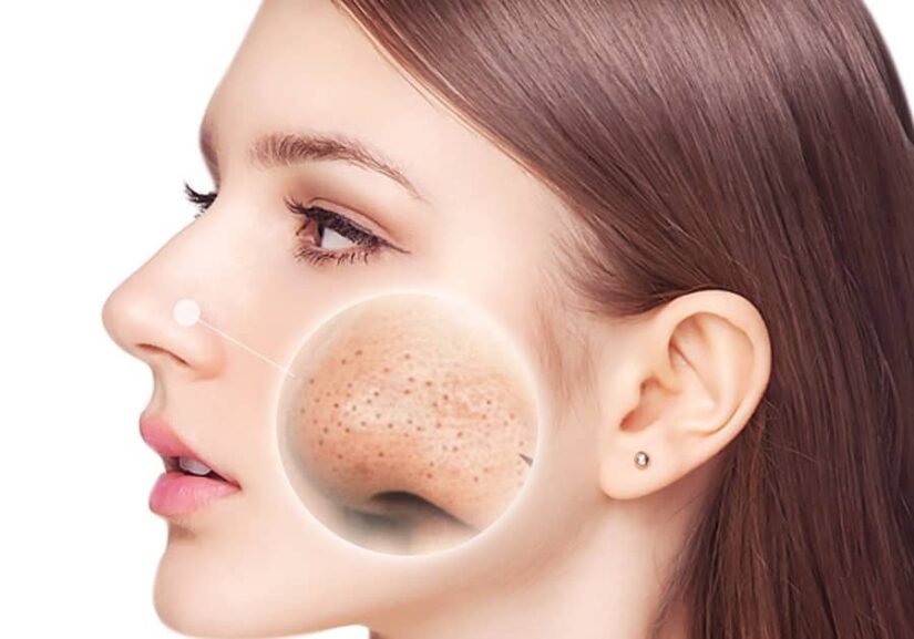 Blackhead Removal: Methods, Remedies, and Prevention